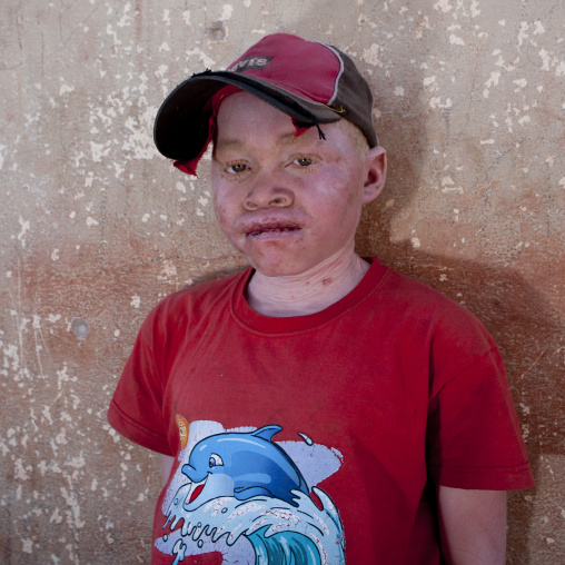 Albinos Boy Called Zekena, Iona Village, Angola