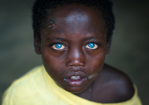 Ethiopian boy called abushe with blue eyes suffering from waardenburg syndrome, Omo valley, Jinka, Ethiopia