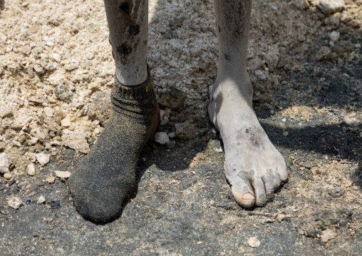 Borana tribe man feet wounded after diving in the volcano crater to collect salt, Oromia, El Sod, Ethiopia