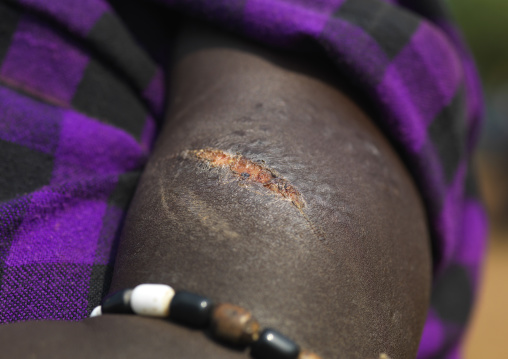 Mursi Arm Deep Wound Scarification Ethiopia