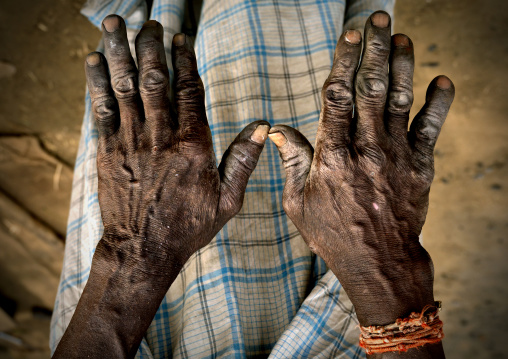 Calloused Hands Of A Blacksmith In Pondicherry, India