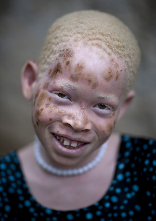 Zamda, Albino girl in mikindani, Tanzania