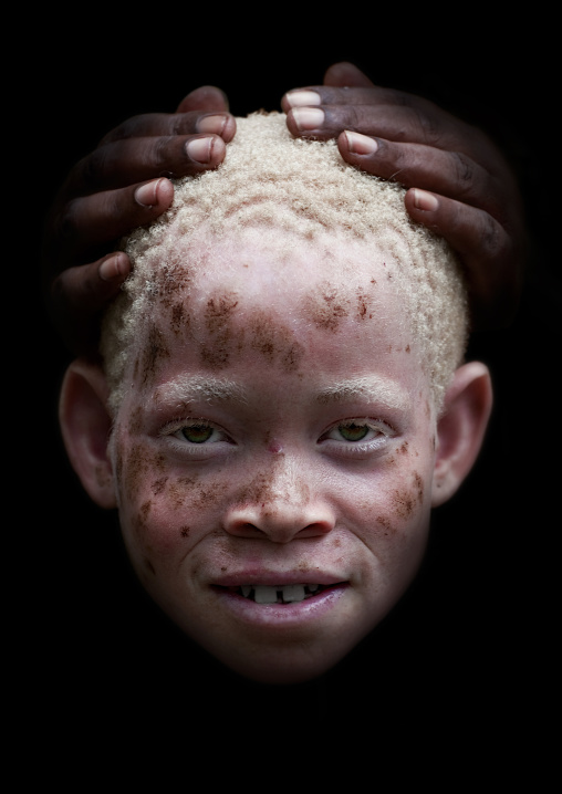 Zamda, Albino girl in mikindani, Tanzania
