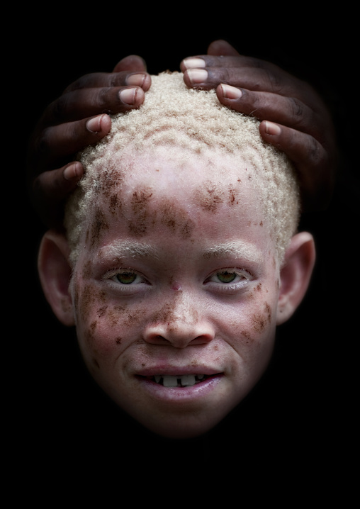 Zamda, Albino girl in mikindani, Tanzania