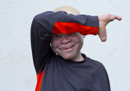 Tanzania, East Africa, Dar es Salaam, emmanuel festo a boy with albinism at under the same sun house, his left arm
was hacked off above the elbow, he lost fingers on the right hand and his to