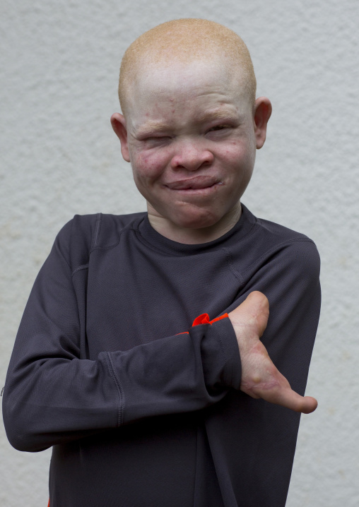 Tanzania, East Africa, Dar es Salaam, emmanuel festo a boy with albinism at under the same sun house, his left armwas hacked off above the elbow, he lost fingers on the right hand and his to