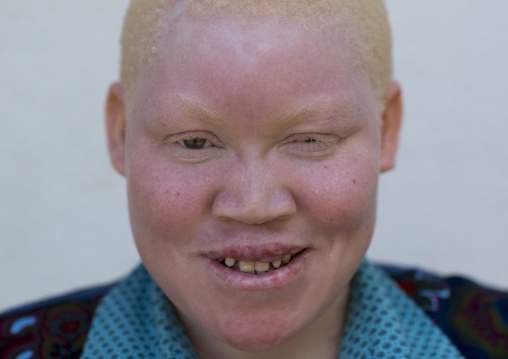 Tanzania, East Africa, Dar es Salaam, kulwa lusana a girl with albinism at under the same sun house, she lost one hand