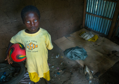 Ethiopian boy called abushe with blue eyes suffering from waardenburg syndrome, Omo valley, Jinka, Ethiopia