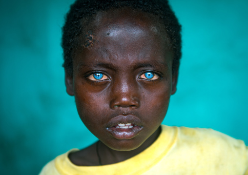 Ethiopian boy called abushe with blue eyes suffering from waardenburg syndrome, Omo valley, Jinka, Ethiopia