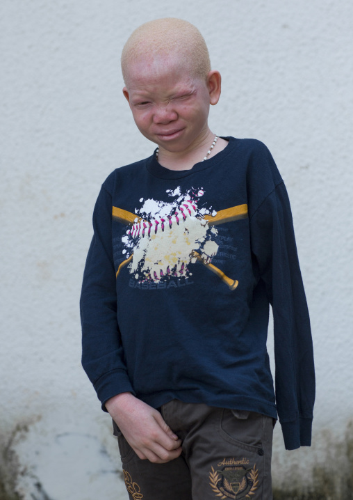 Tanzania, East Africa, Dar es Salaam, mwigulu matonange a boy with albinism at under the same sun house, some men hacked off his left arm with a machete