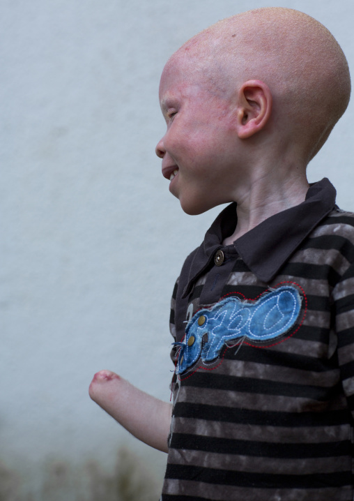 Tanzania, East Africa, Dar es Salaam, baraka cosmas a boy with albinism at under the same sun house, he lost his right hand in a witchcraft attack