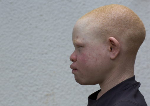 Tanzania, East Africa, Dar es Salaam, emmanuel festo a boy with albinism at under the same sun house, his left arm
was hacked off above the elbow, he lost fingers on the right hand and his to