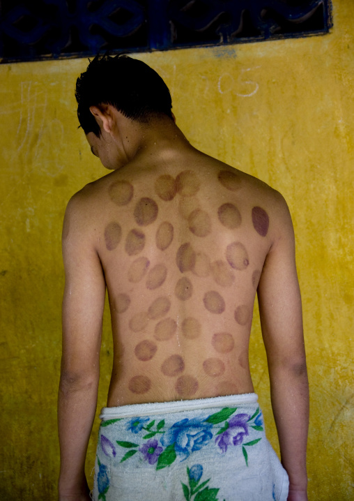 Young man who received vacuum cupping treatment, Battambang province, Battambang, Cambodia