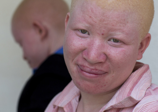 Tanzania, East Africa, Dar es Salaam, jenipher stanford a teen with albinism at under the same sun house