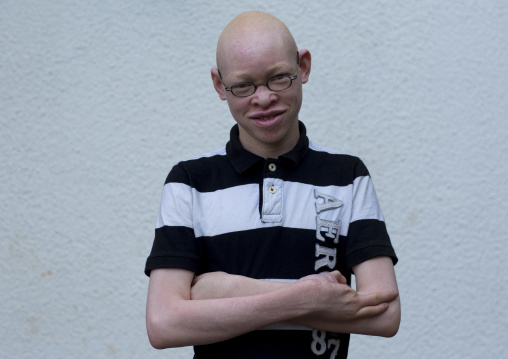 Tanzania, East Africa, Dar es Salaam, adam robert a boy with albinism at under the same sun house, he had three fingers cut